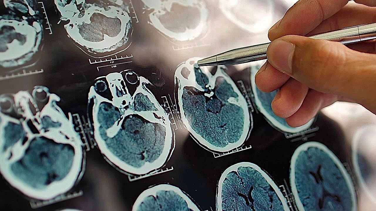 Video: A new blood test could detect Alzheimer's years before symptoms appear