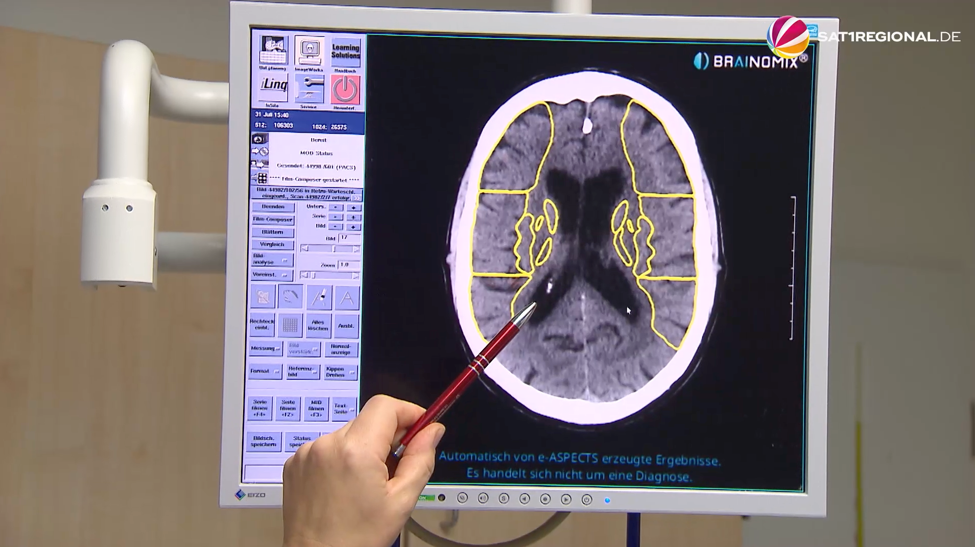 Video: Künstliche Intelligenz in der Diagnostik: Schnelle Erkennung von Schlaganfällen