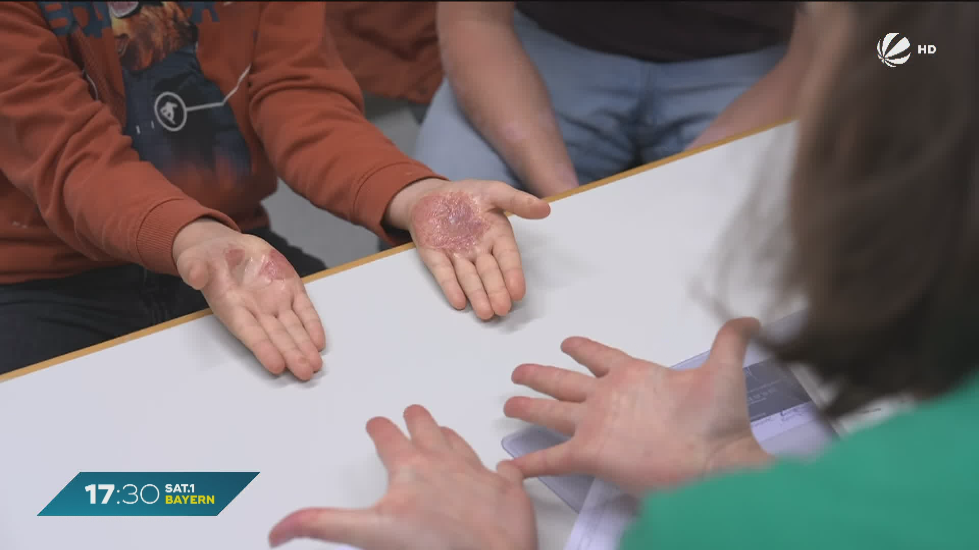 Video: Brandverletzungen bei Kindern: Aktionstag in Nürnberg soll sensibilisieren